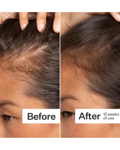 Clearance Act + Acre Scalp Serum Hair
